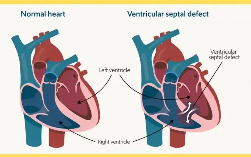 heart defects surgery